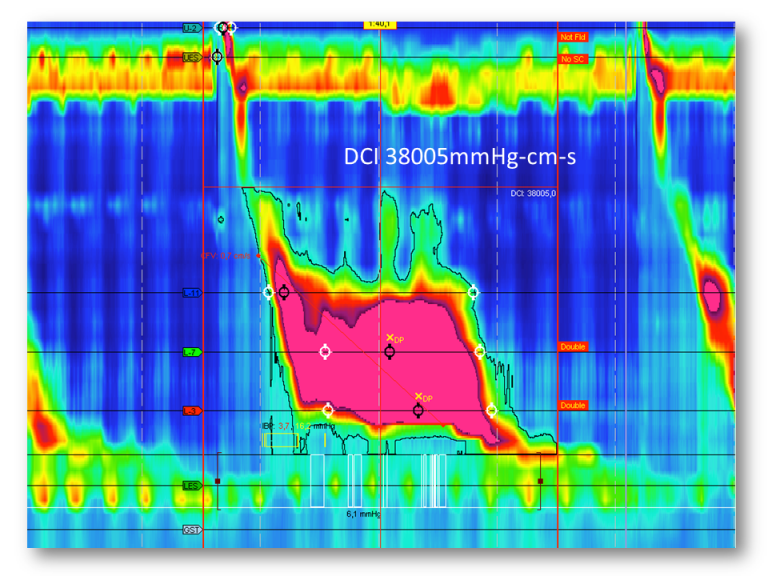 JackhammerÖsophagus Achalasie.info