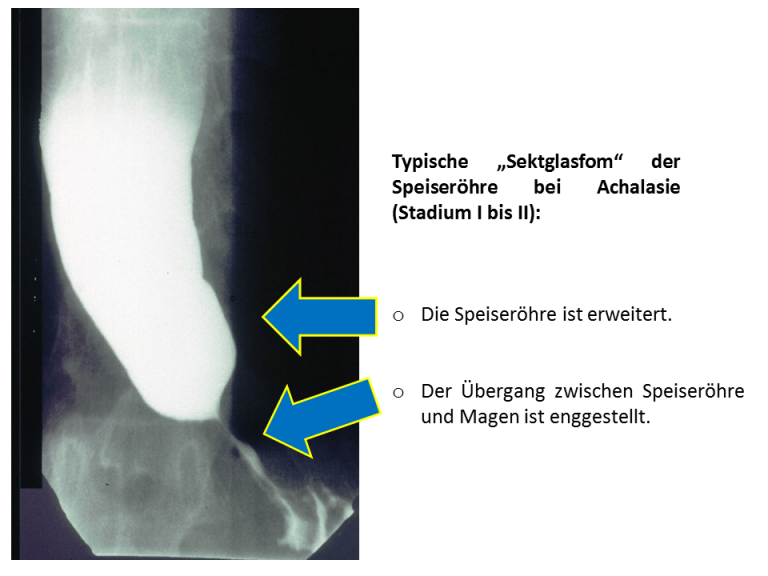 Breischluckuntersuchung - Achalasie.info