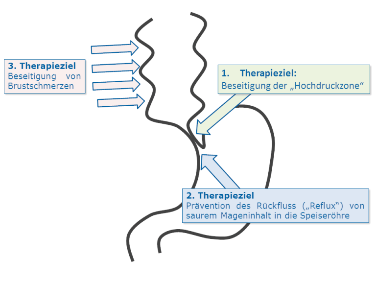 Therapieziel Achalasie Achalasie Info